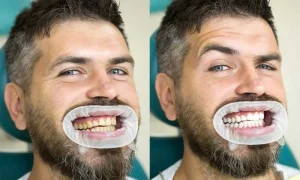 Boulevard Dental - Teeth Whitening Results in Saskatoon