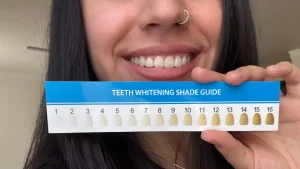 Boulevard Dental - Teeth Whitening Shade Guide in Saskatoon