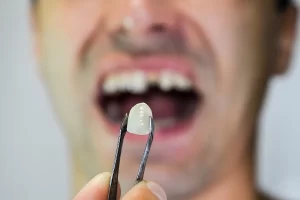 Boulevard Dental - Emergency Chipped Tooth